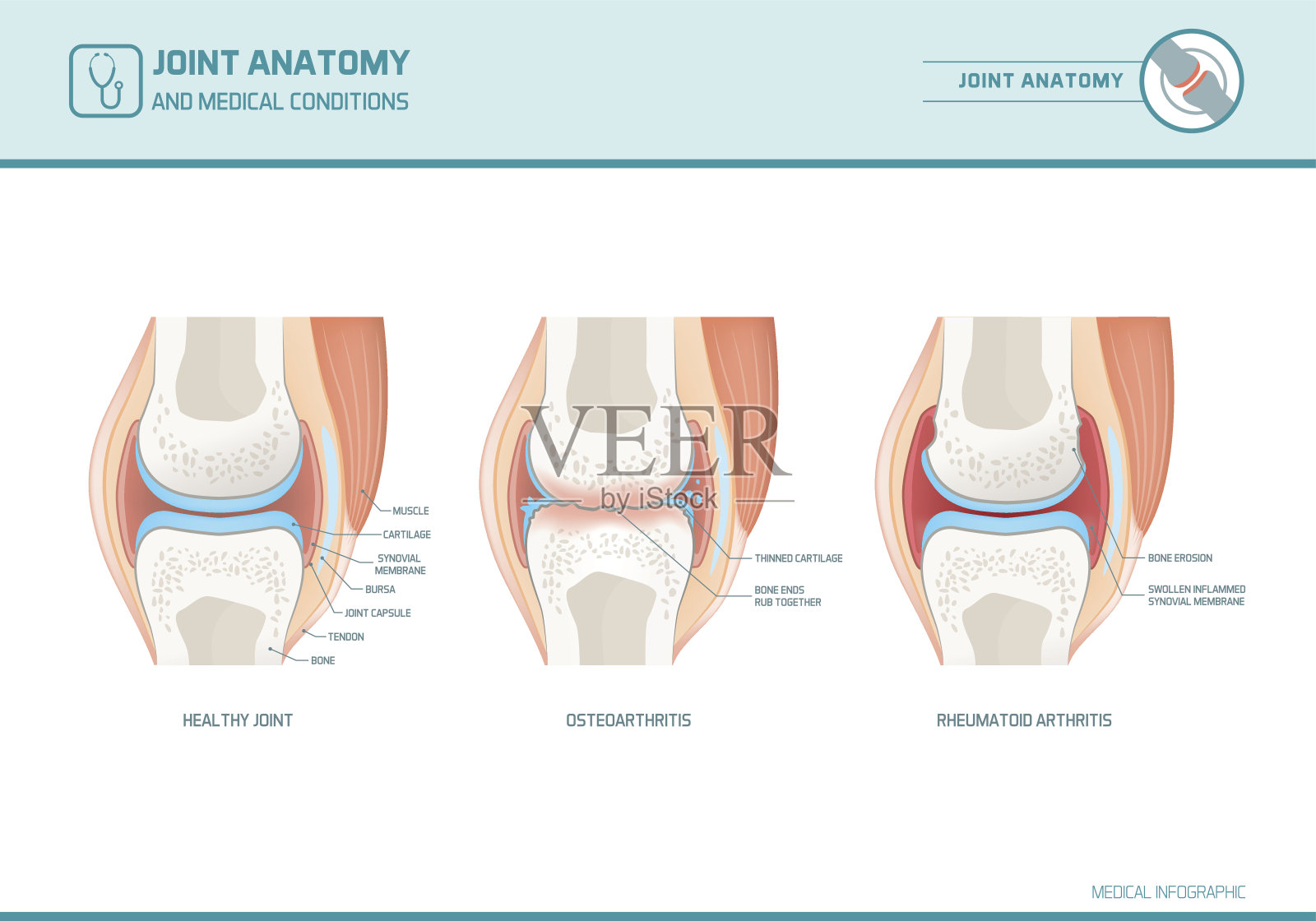 关节解剖，骨关节炎和类风湿性关节炎信息图设计元素图片