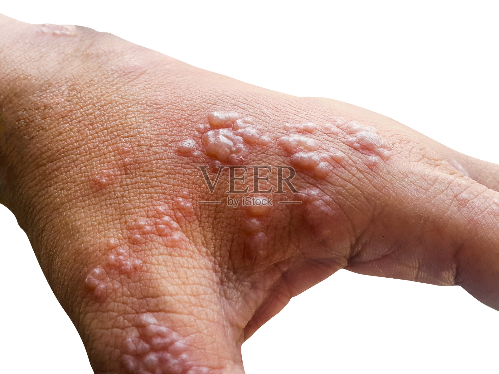手臂皮肤感染带状疱疹病毒照片摄影图片