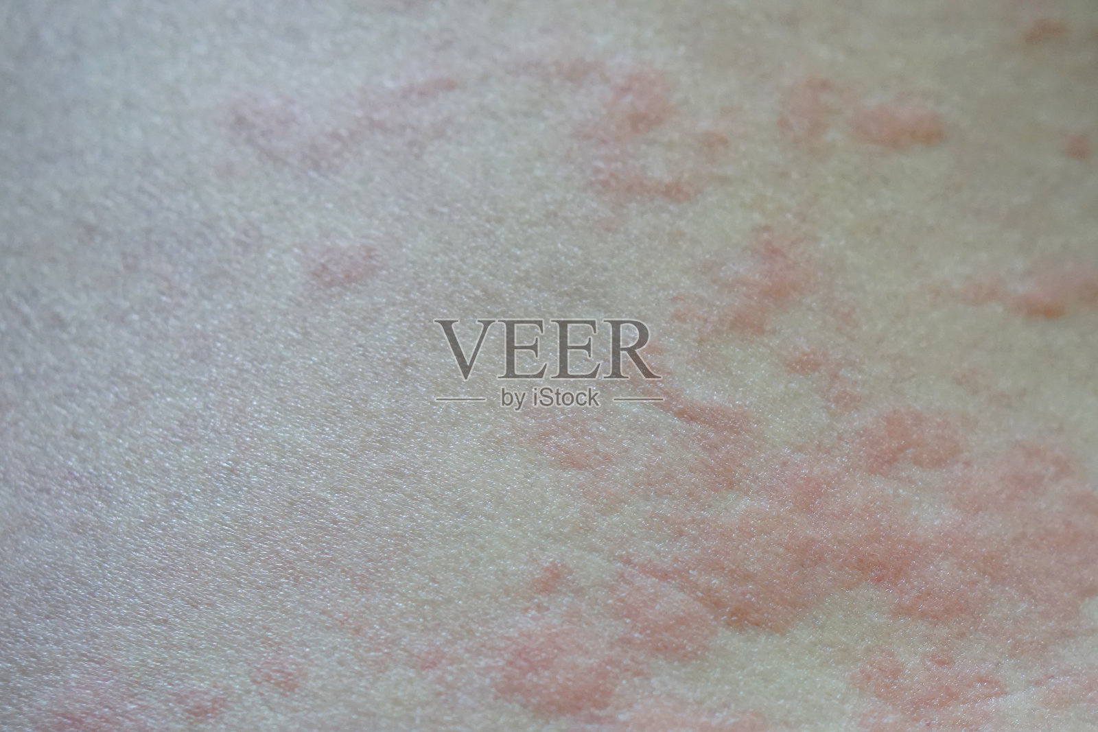 荨麻疹又称荨麻疹，是一种皮肤起红、隆起、发痒的肿块的皮疹。照片摄影图片