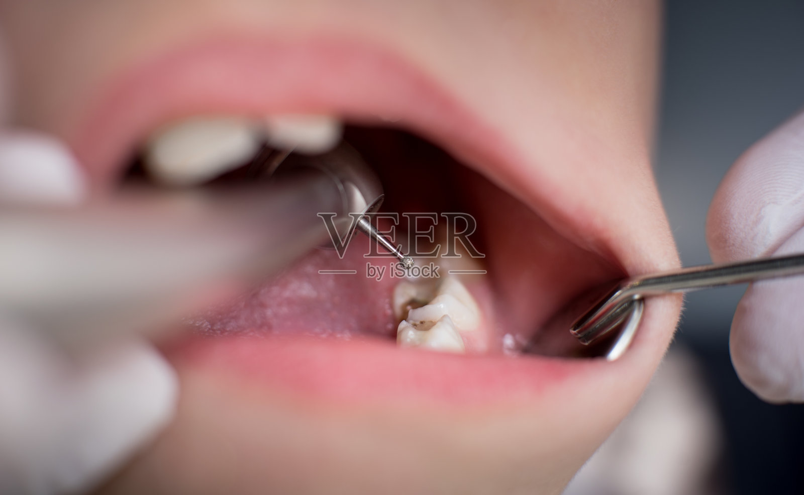 在牙科诊所牙科医生作打孔治疗时张口。特写镜头。牙科照片摄影图片