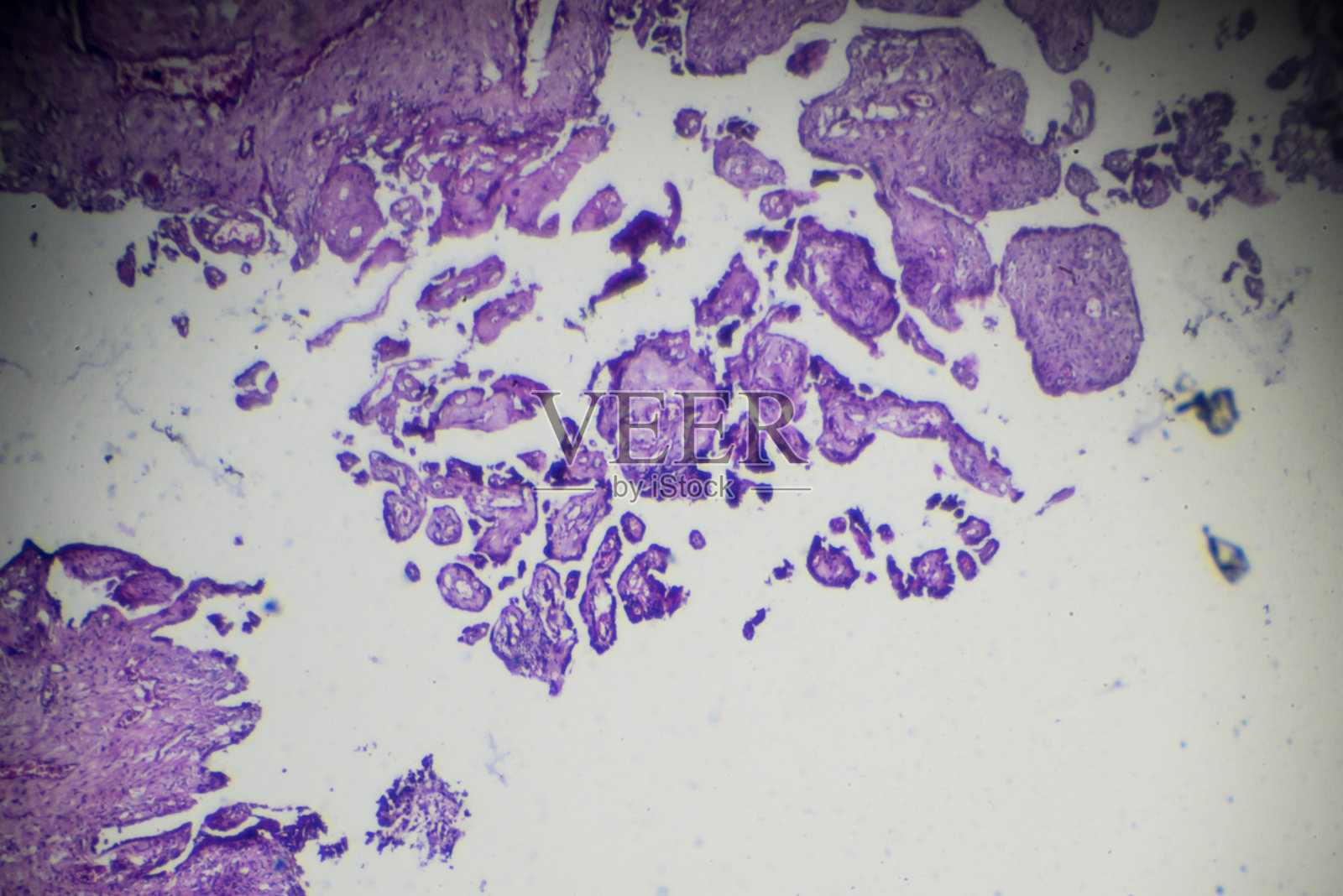卵巢囊腺瘤不同部位光镜下活检照片摄影图片