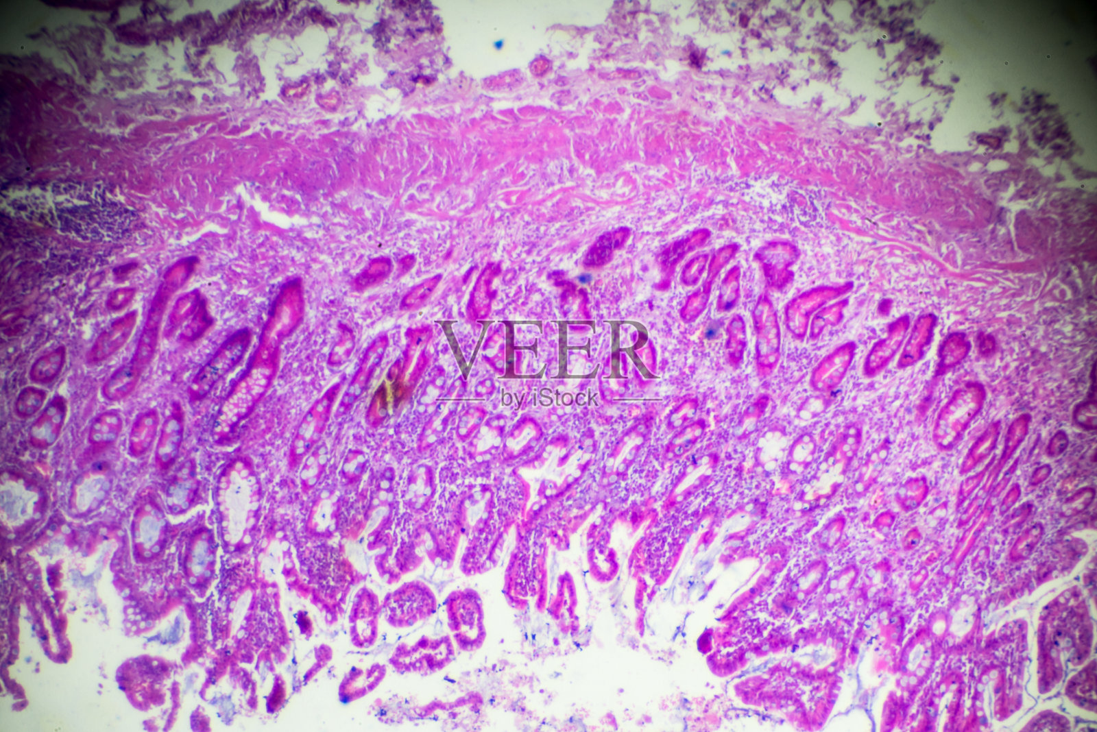 胃腺癌(管状腺癌)照片摄影图片