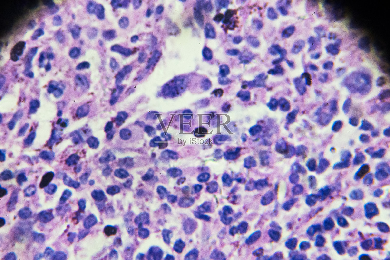 显微镜下的非霍奇金淋巴瘤照片摄影图片