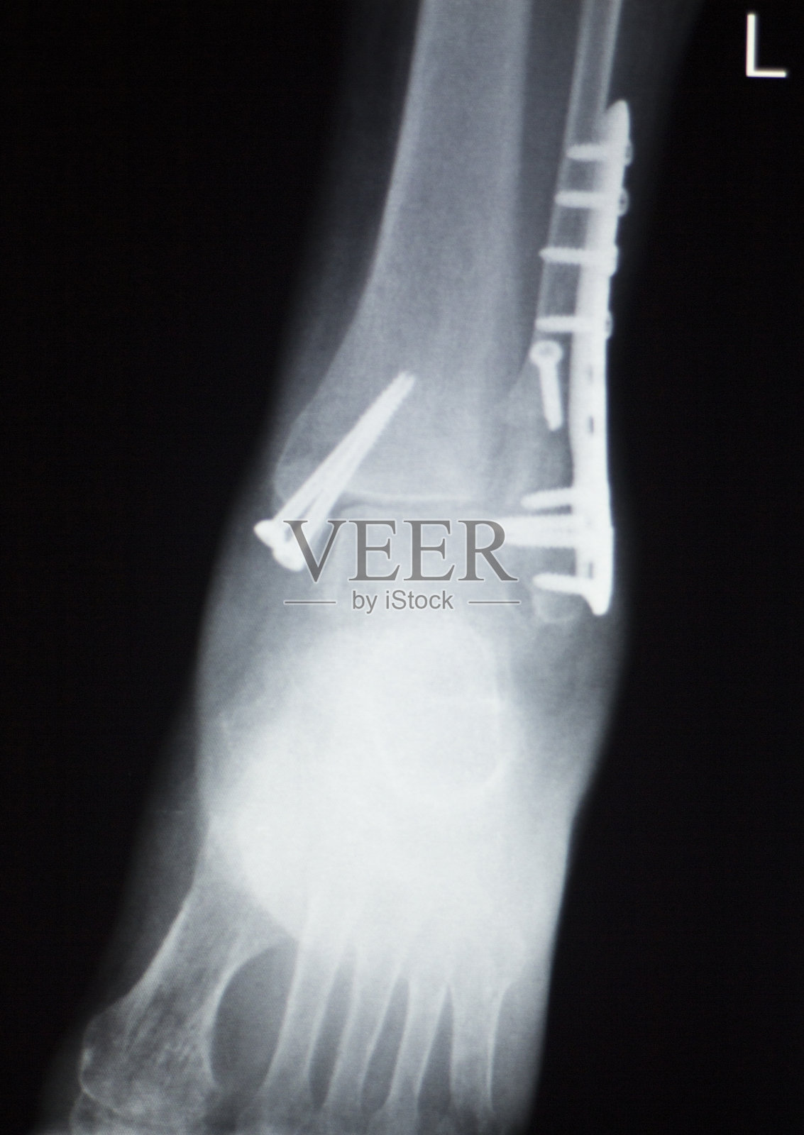 踝关节足关节矫形钛金属创伤科钢板及螺钉植入伤患者x线影像。照片摄影图片