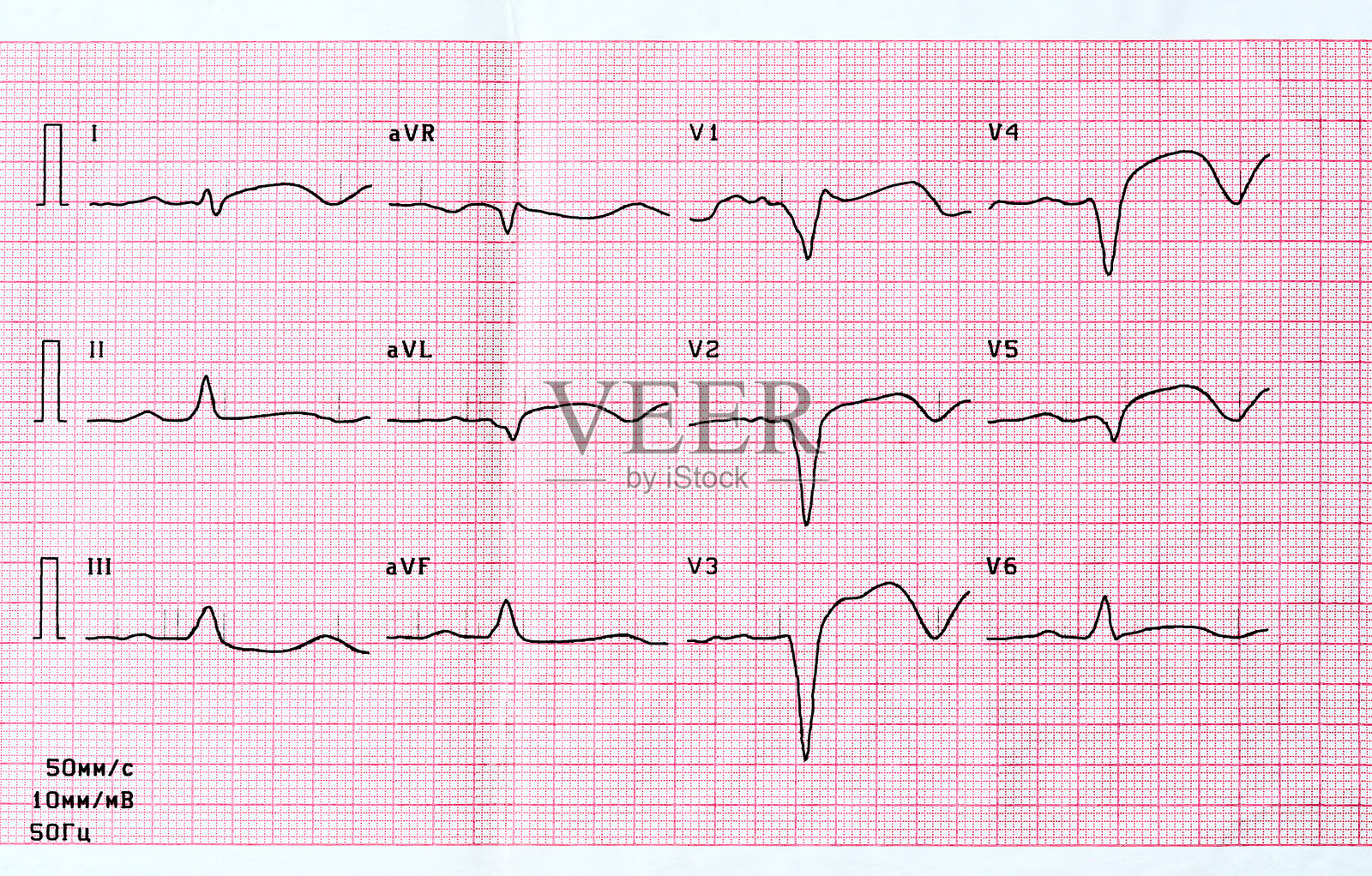心电图显示大面积前心肌梗死的急性期照片摄影图片