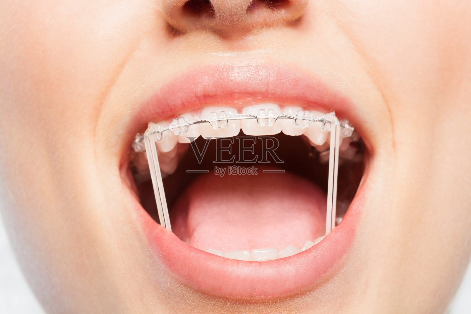 女人的嘴，带着矫正牙齿的橡皮筋照片摄影图片