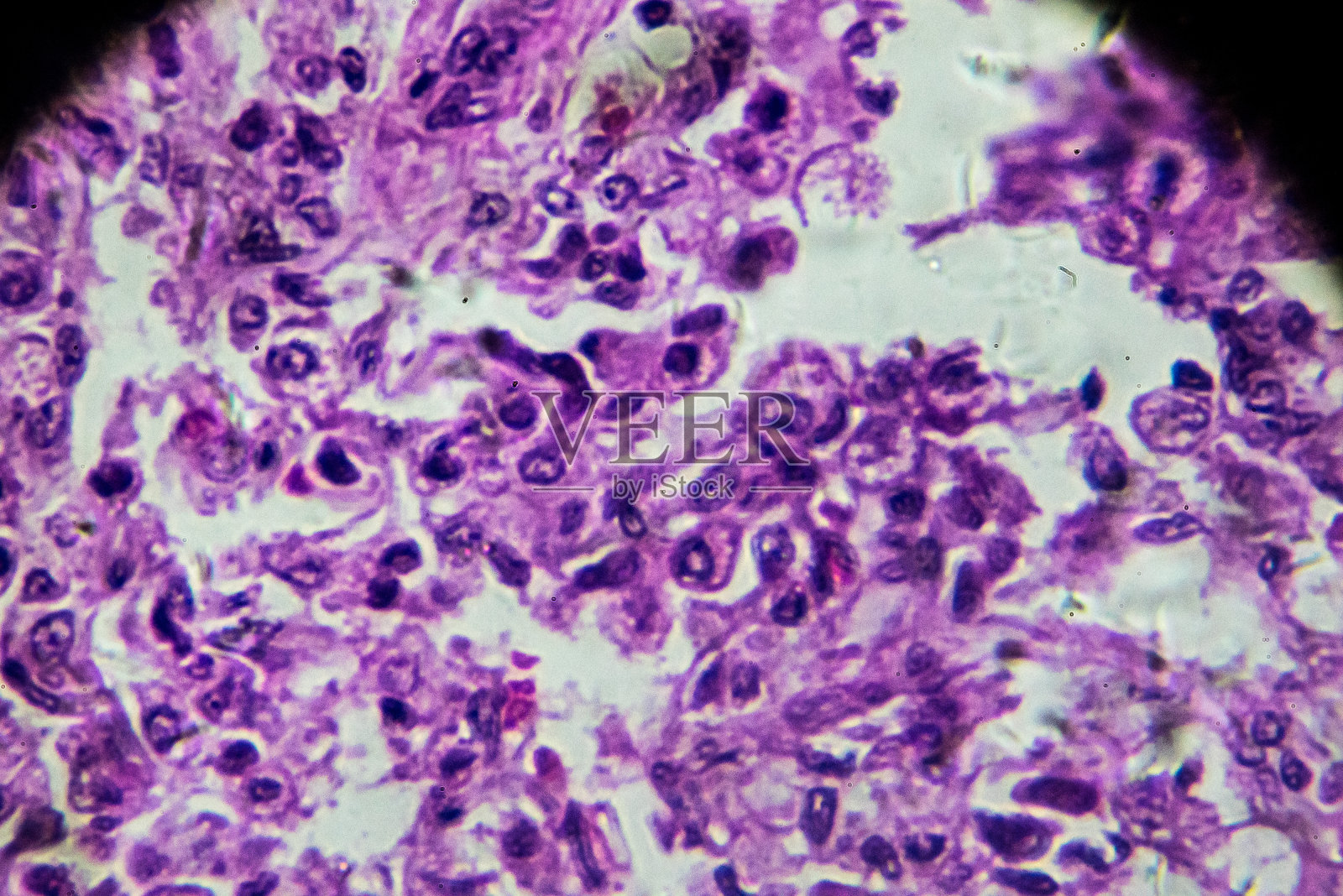 显微镜下小叶性肺炎人体病理生物样本照片摄影图片
