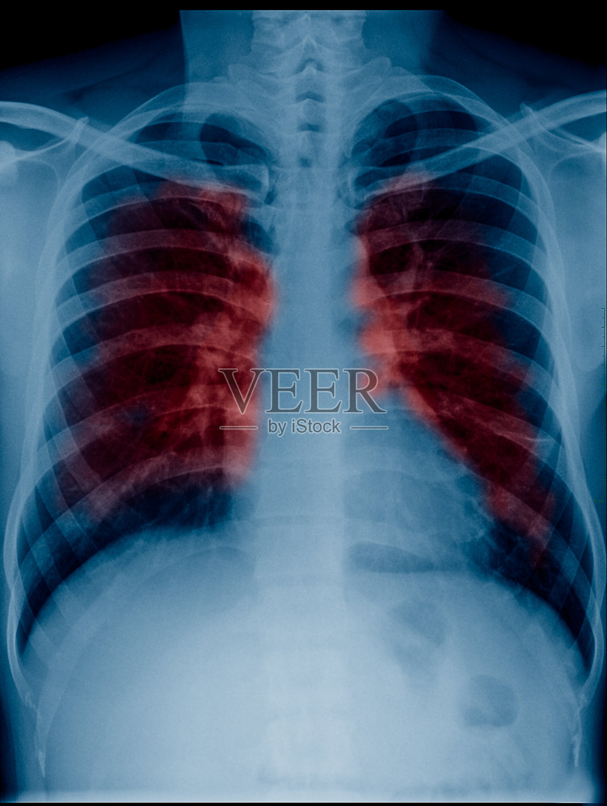 在医学诊断中用于检查肺部的成人x光片上，红色显示肺部有分泌物或癌症照片摄影图片