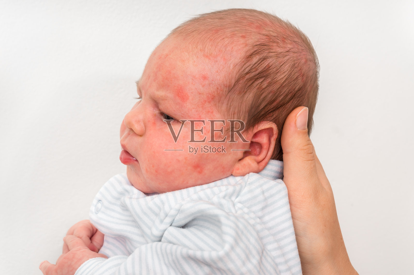 新生儿皮疹。出生后的过敏反应。照片摄影图片