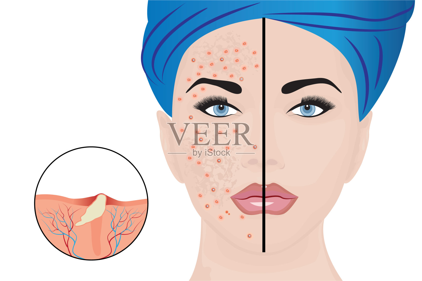 一个女人脸上的痤疮脓疱和治疗结果插画图片素材