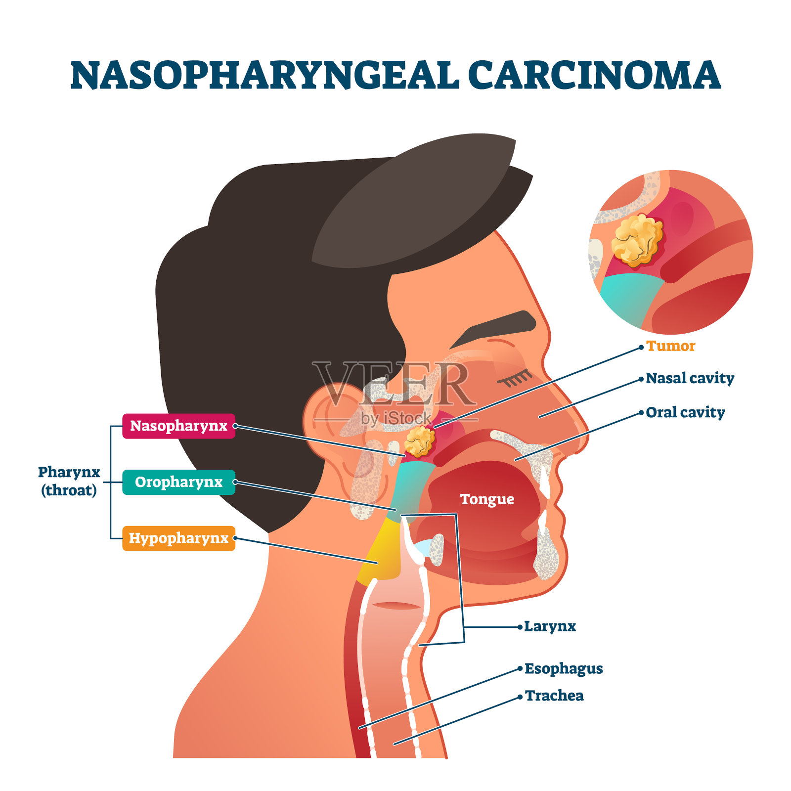 鼻咽癌肿瘤，矢量图插画图片素材
