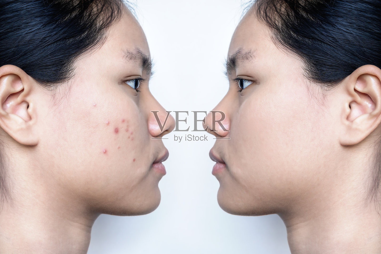 年轻的亚洲妇女面对治疗前和后痤疮白色背景。皮肤护理的概念。照片摄影图片