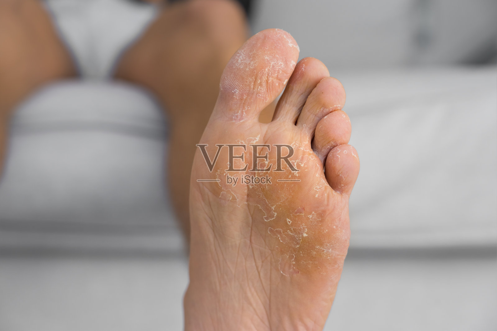 近距离观察脱皮和龟裂的脚。真菌感染或足癣、皮肤干燥、皮炎、湿疹、牛皮癣、过敏反应、脚出汗或脱水照片摄影图片
