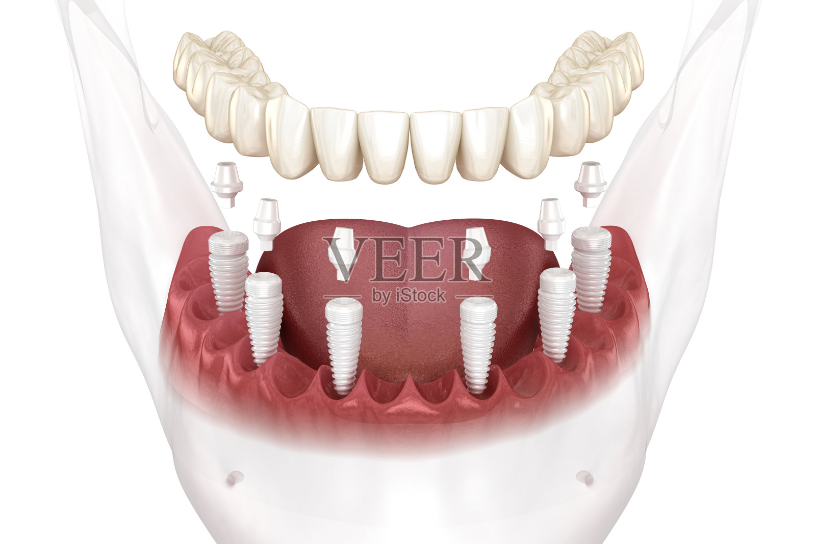 可摘下颌假体全部在6个系统上，由陶瓷种植体支持。医学上准确的人类牙齿和假牙的3D插图照片摄影图片