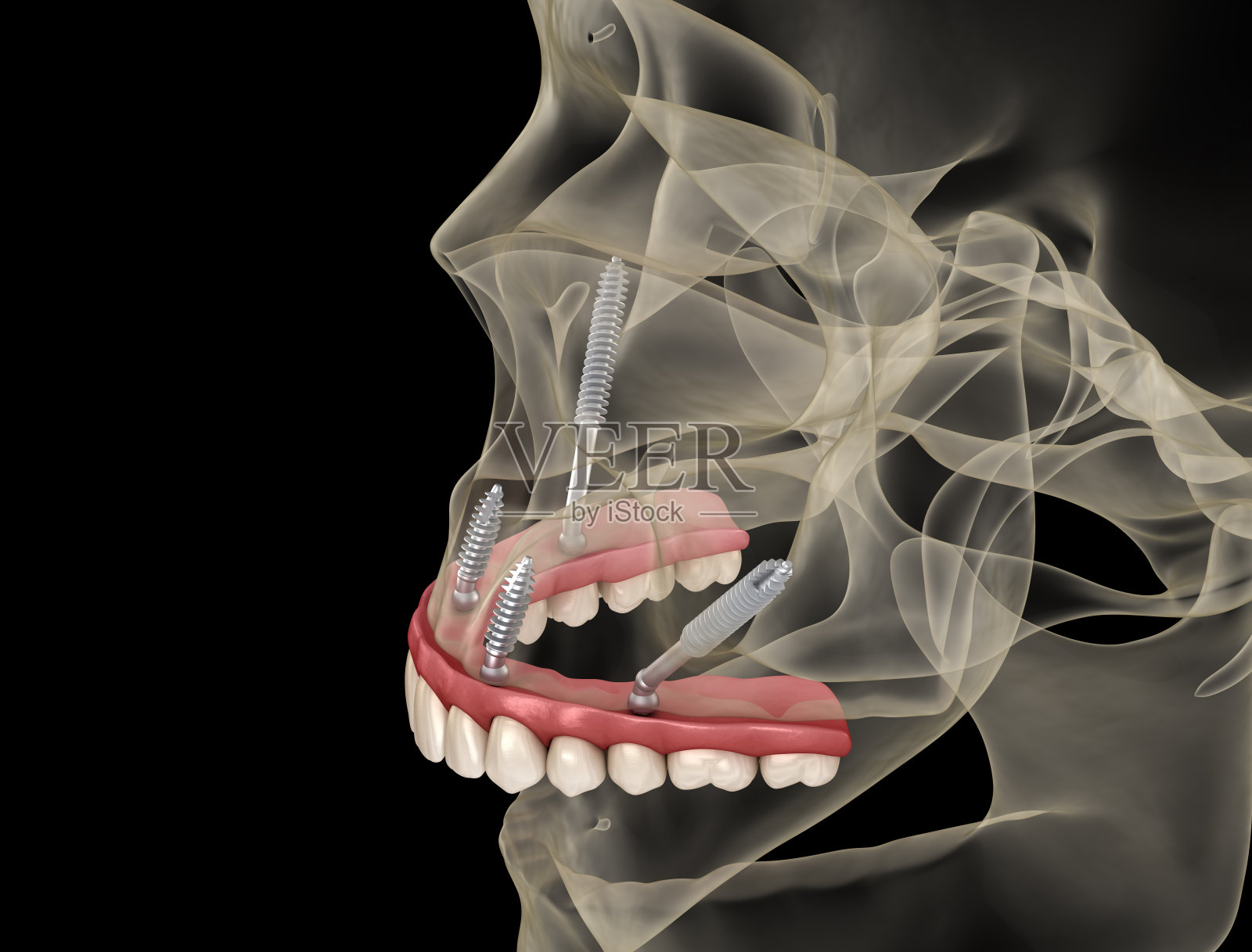 上颌假体由颧骨植入物支撑。医学上准确的人类牙齿和假牙的3D插图照片摄影图片