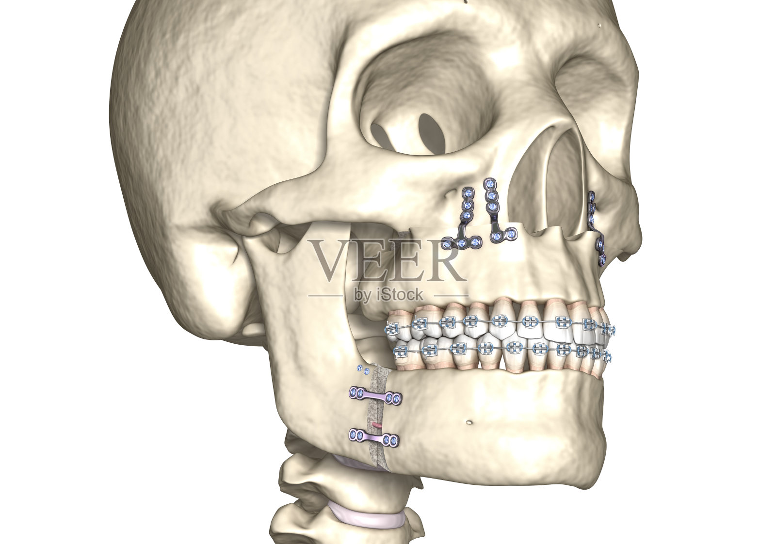 下颌进步手术。医学上准确的牙科3D插图。照片摄影图片