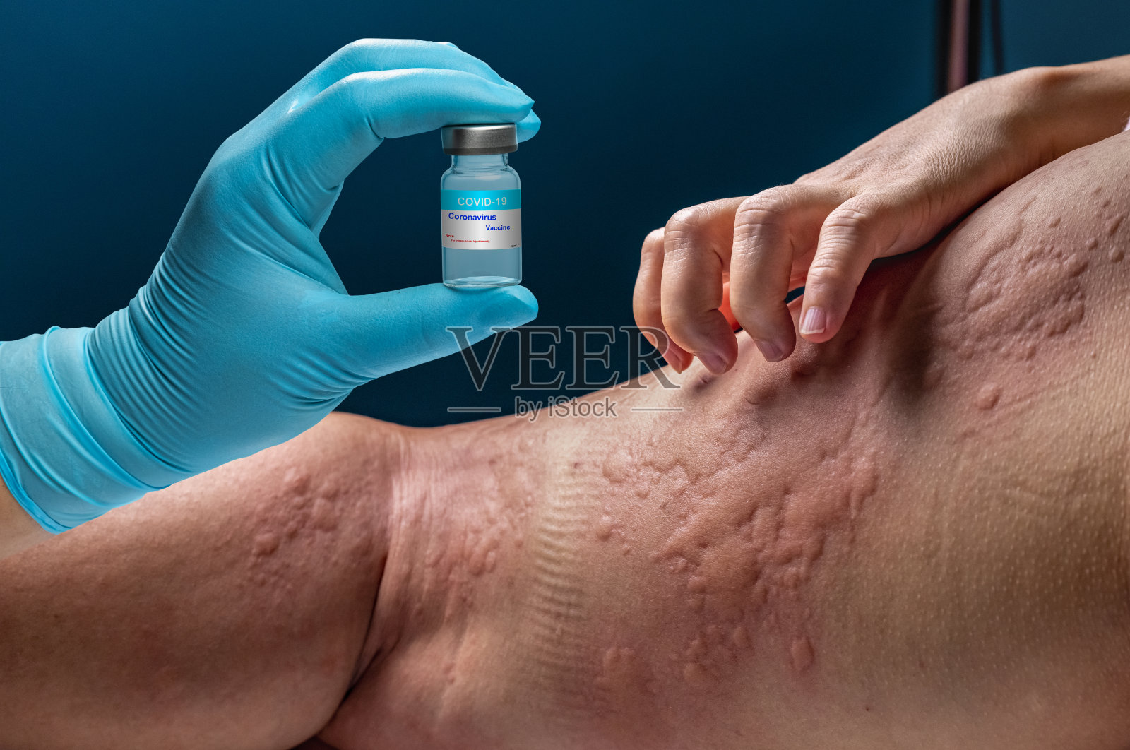 疫苗接种后老年人covid - 19过敏症状。照片摄影图片