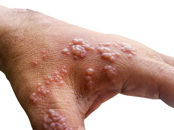 手臂皮肤感染带状疱疹病毒图片下载